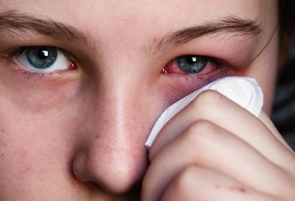 Viêm mắt cũng là một biến chứng bệnh lậu