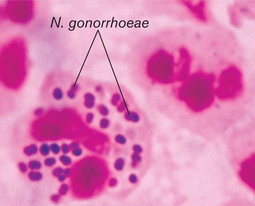 Bệnh lậu do lậu cầu khuẩn neisseria gonorrhoeae gây ra