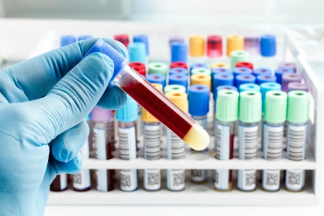 Xét nghiệm máu có phát hiện bệnh lậu không?