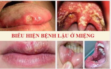 Biểu hiện bệnh lậu ở miệng là gì?