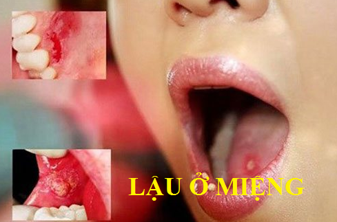 Lậu ở miệng có triệu chứng gì?